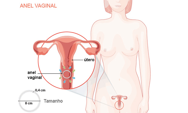 Anel vaginal Anel vaginal