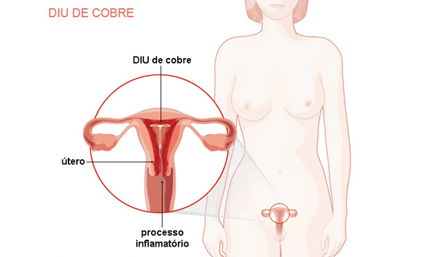 DIU de cobre DIU de cobre