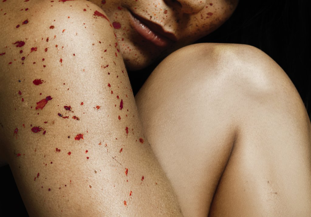 Uma doença chamada púrpura