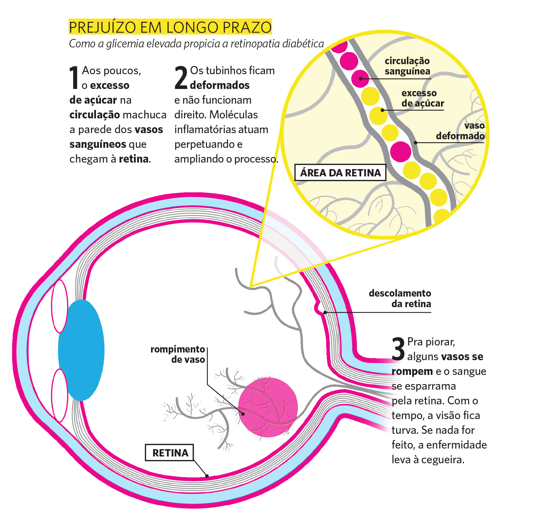 Como a glicemia elevada propicia a retinopatia diab&eacute;tica