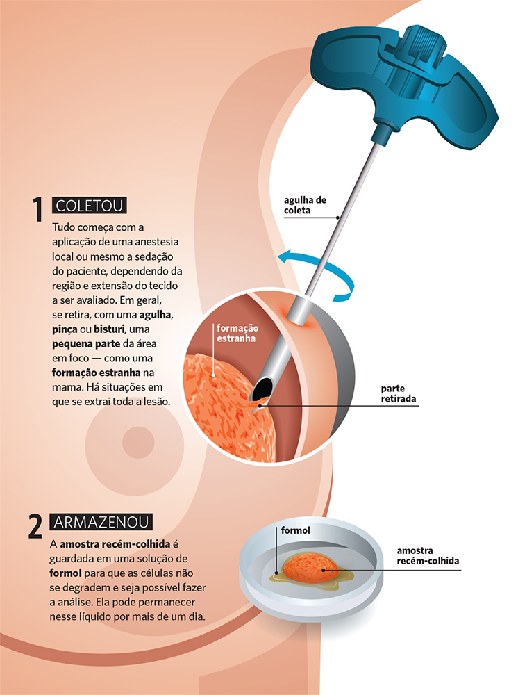 biopsia-como-&eacute;-feita