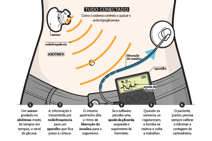 Pâncreas artificial para diabetes