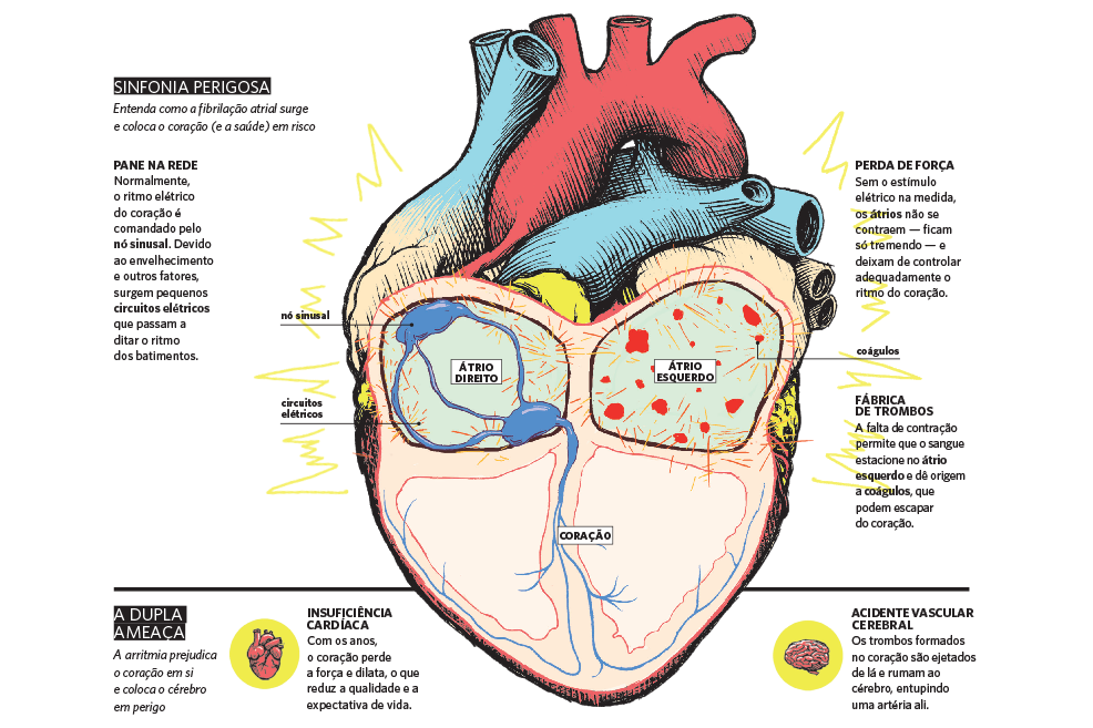 coracao-arritmia-info