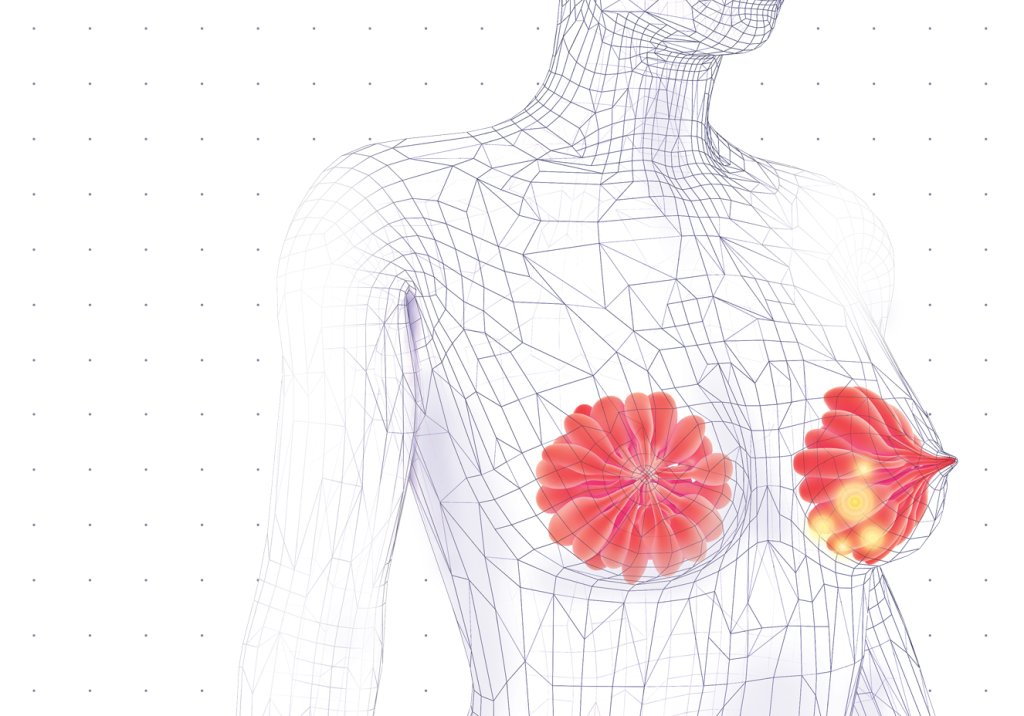 Um método alternativo para rastrear o câncer de mama?