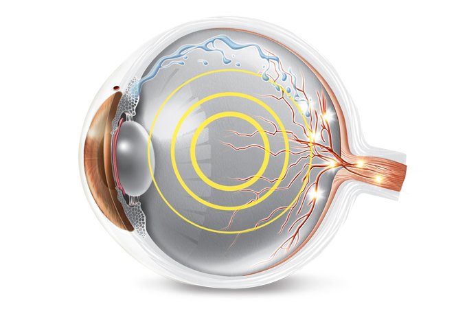 Vem mudança no tratamento do glaucoma: laser pode virar primeira opção