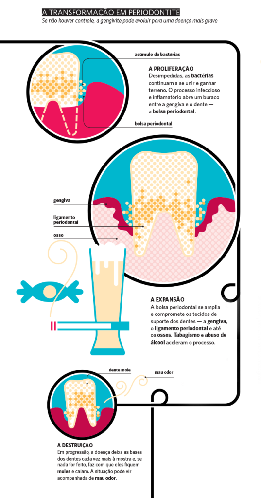 A transformação em periodontite.