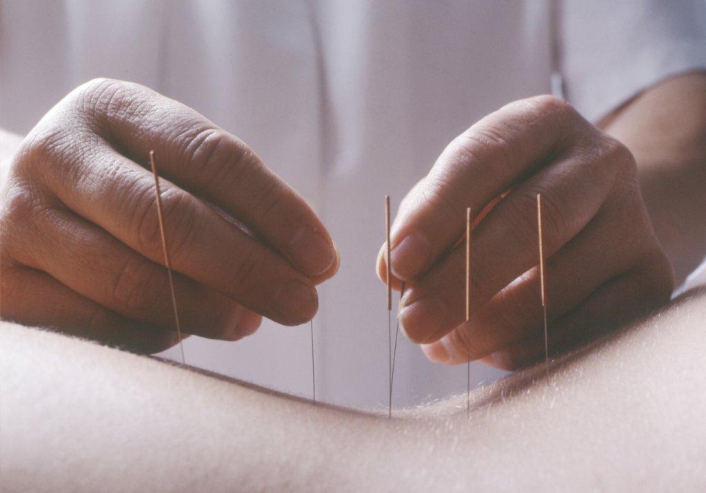 Acupuntura pode aliviar as dores do câncer, segundo revisão de estudos