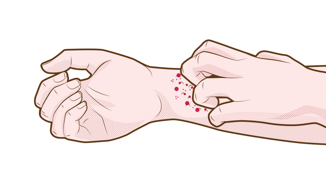 artrite psoriasica