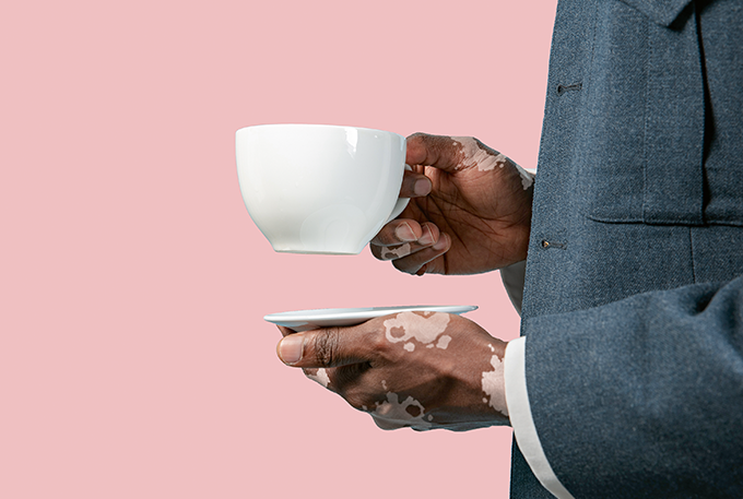 Vitiligo exige cuidados extras em tempos de coronavírus