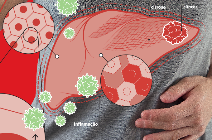 danos ao fígado hepatite C