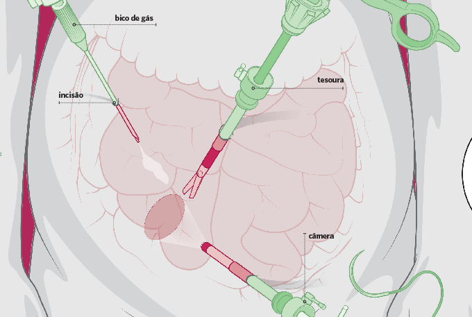 instrumentos para laparoscopia na barriga