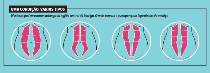 Tipos de diástase