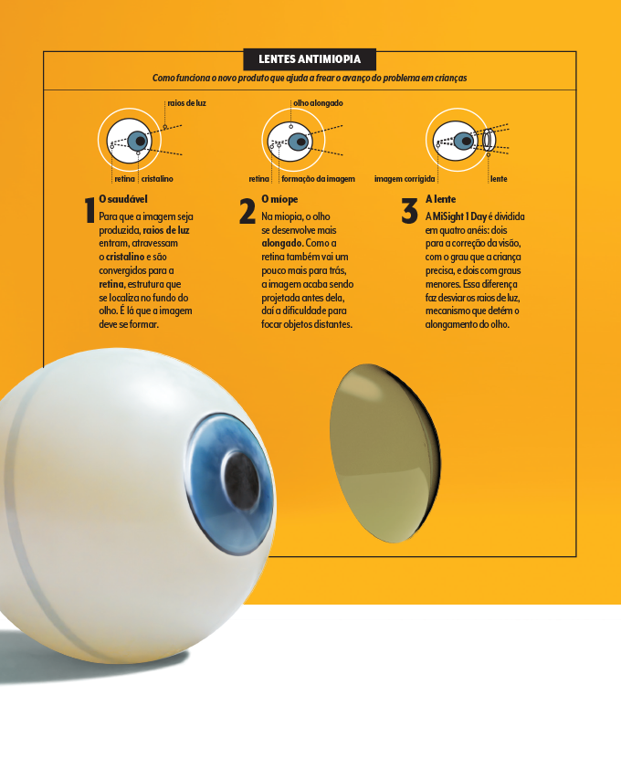 Esquema passo a passo de como funcionam as lentes de contato que tratam miopia em crianças