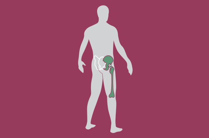 Como é feita a cirurgia de prótese do quadril?