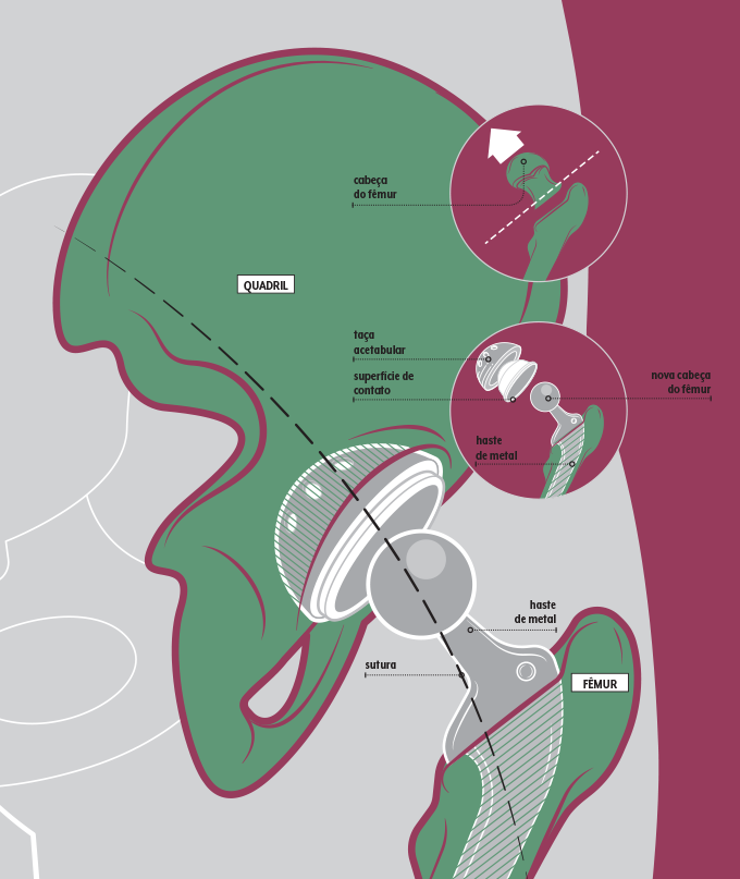 Como é feita uma prótese no quadril