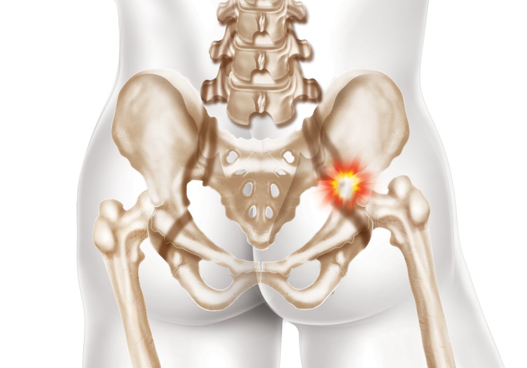 Prótese do quadril: o momento certo para a cirurgia e o que esperar dela