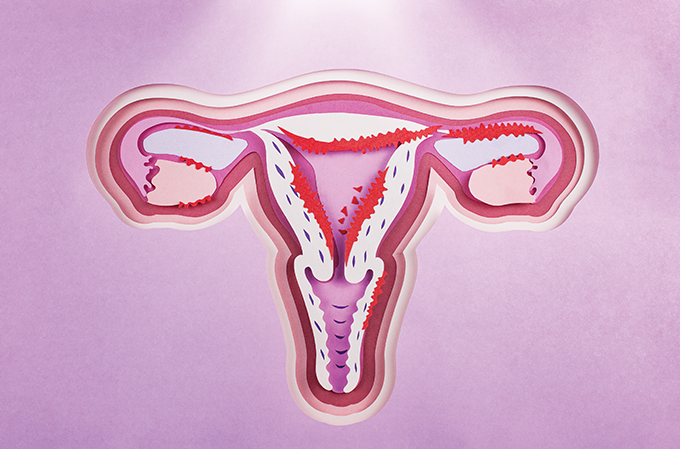 Novas luzes sobre a endometriose