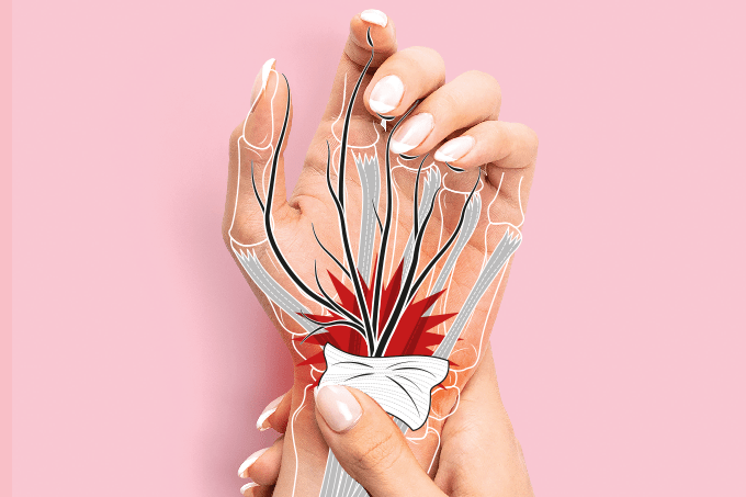 O que é a síndrome do túnel do carpo?