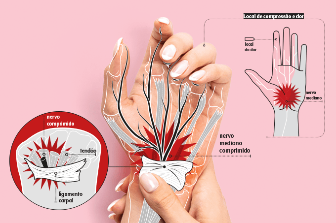 síndrome do túnel do carpo