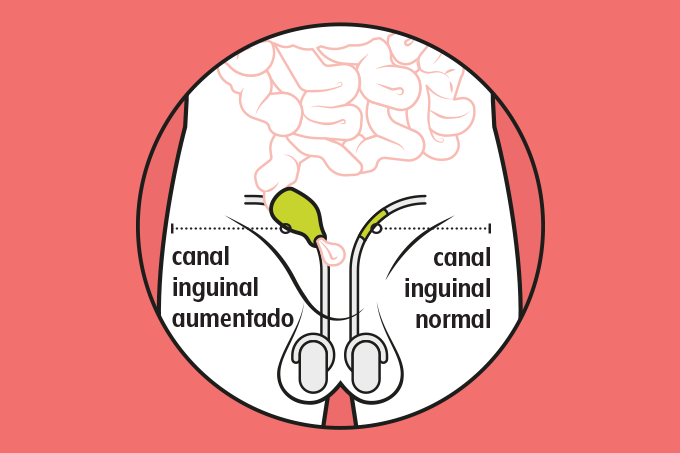 desenho de canal inguinal