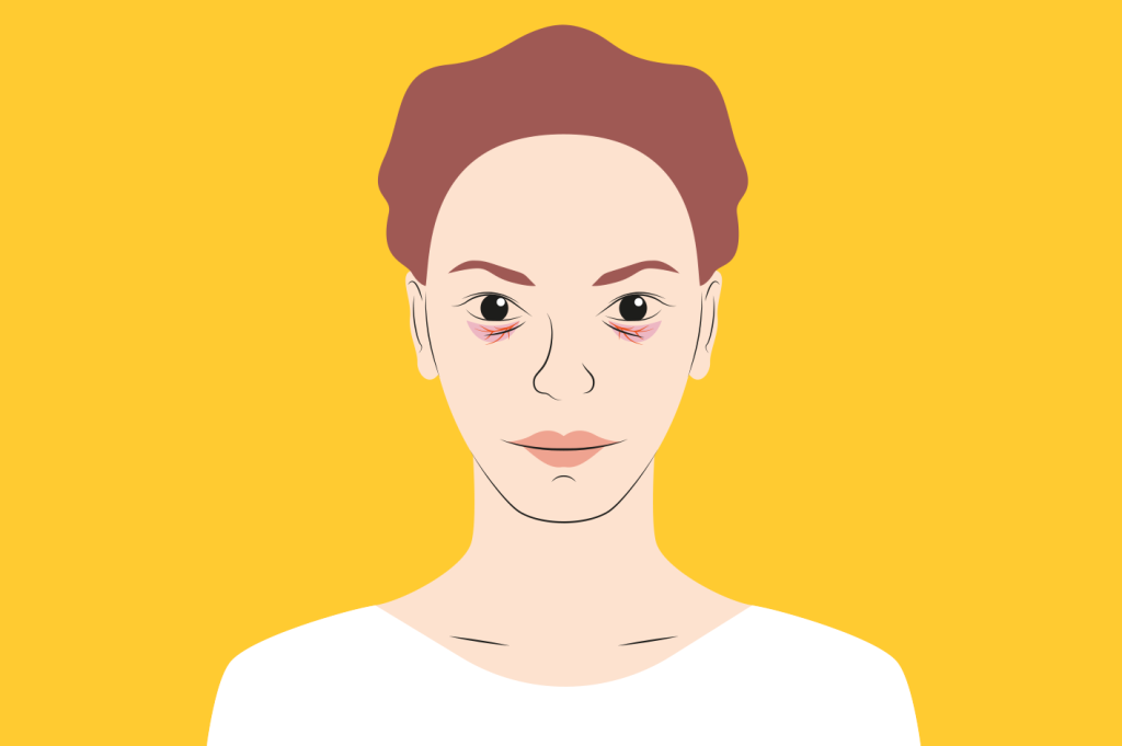 O que causa as olheiras – e como resolvê-las?