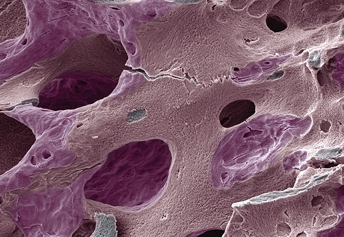 Zoom: quebra-quebra ósseo