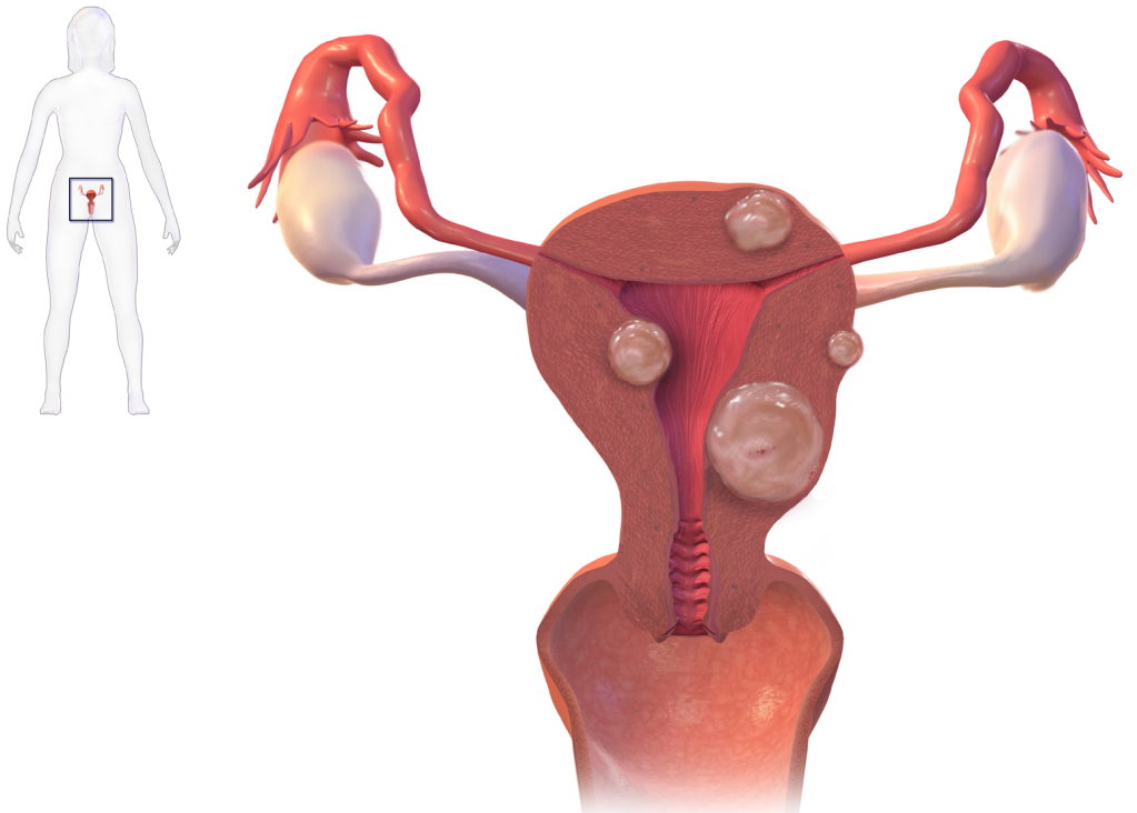 tipos-de-miomas-uterinos