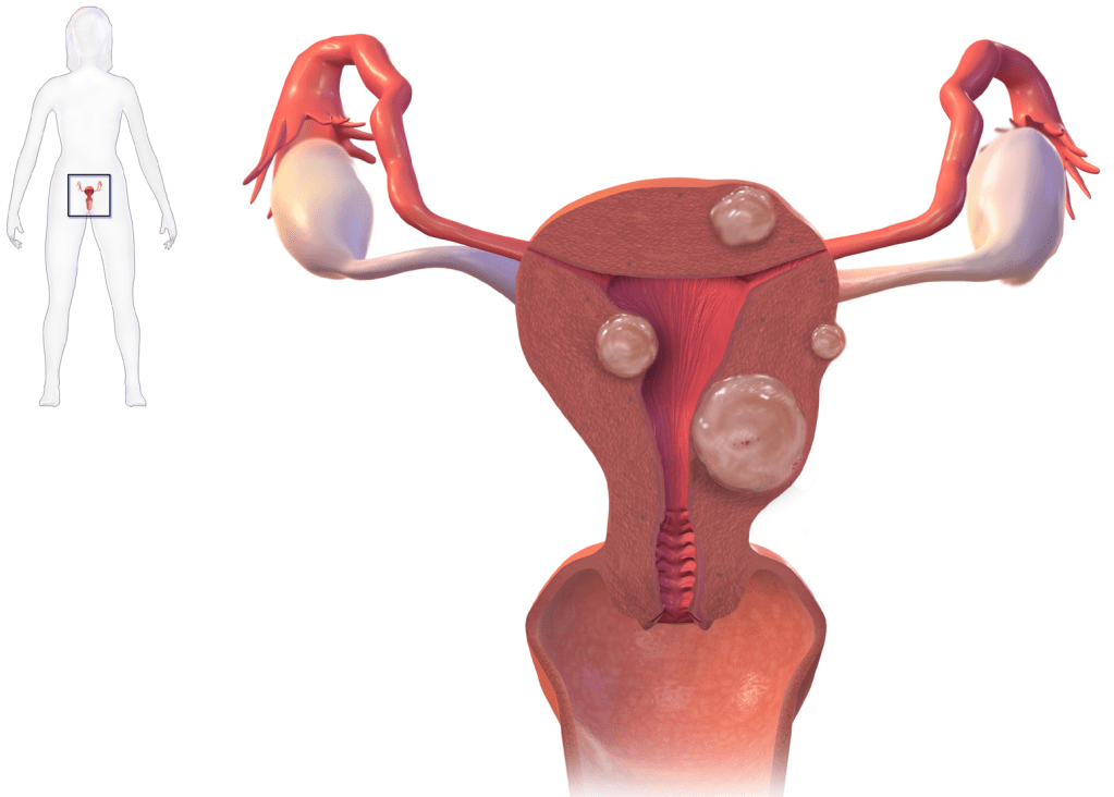 miomas-uterinos-tipos Diferentes tipos de miomas uterinos