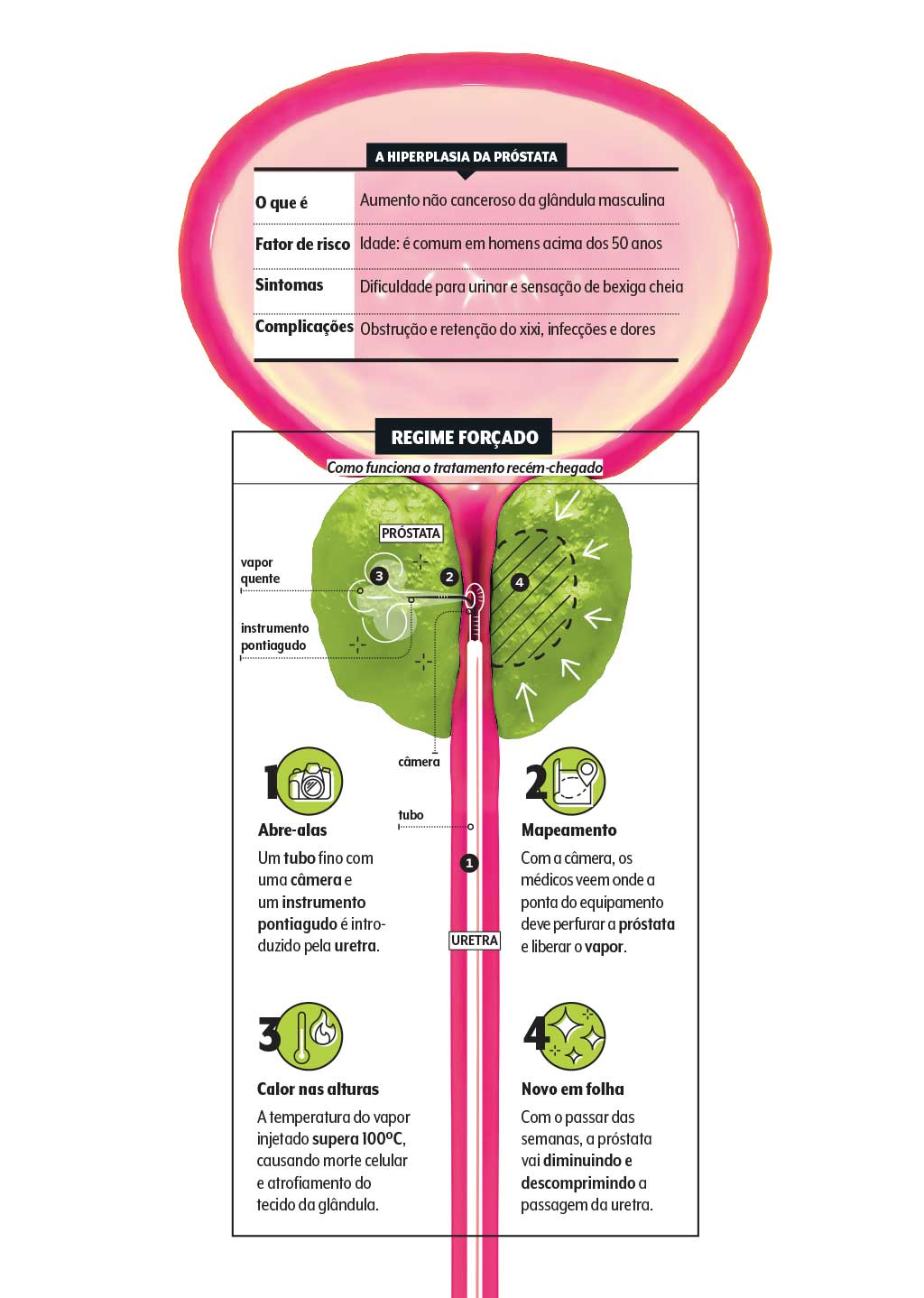 hiperplasia-prostata-info Entenda o que é a hiperplasia benigna da próstata e como funciona o novo tratamento