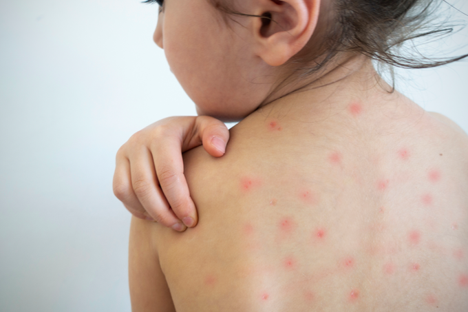 Sarampo: OMS alerta para aumento de casos e Brasil registra infecção