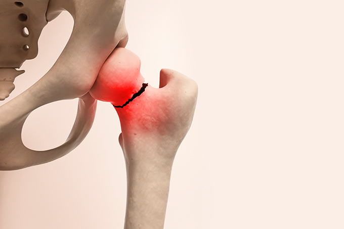osteoporose