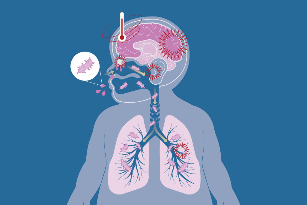 Coqueluche: uma ameaça contínua à saúde pública