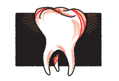 infiltracao-dentaria