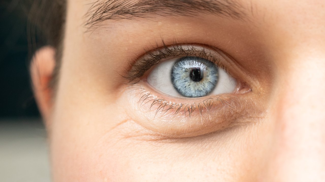 blefaroplastia-o-que-e-cirurgia-estetica-sem-corte