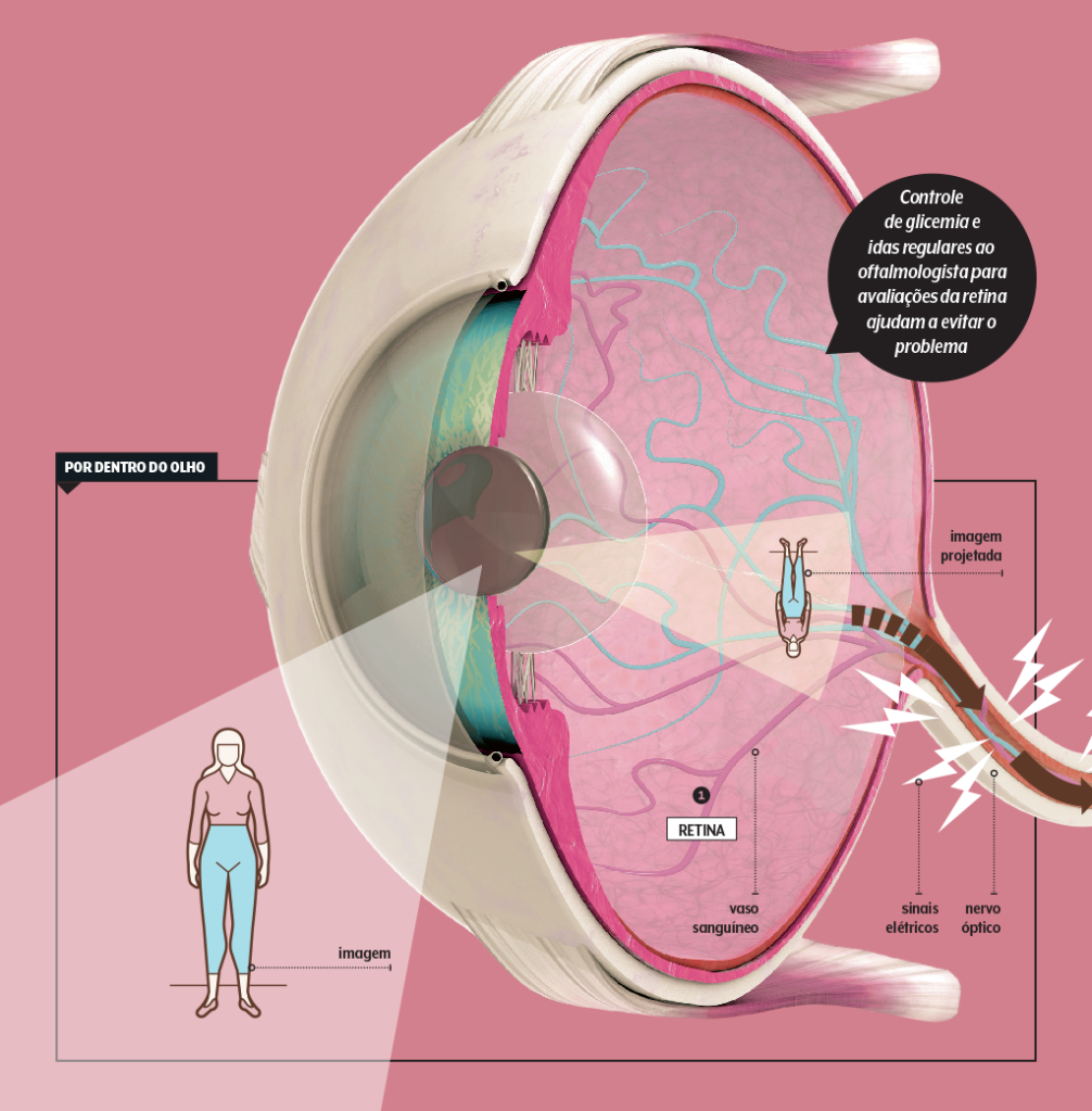 508-sqs-retinopatia-diabetica-info-parte1 retinopatia-diabetica-como-ocorre