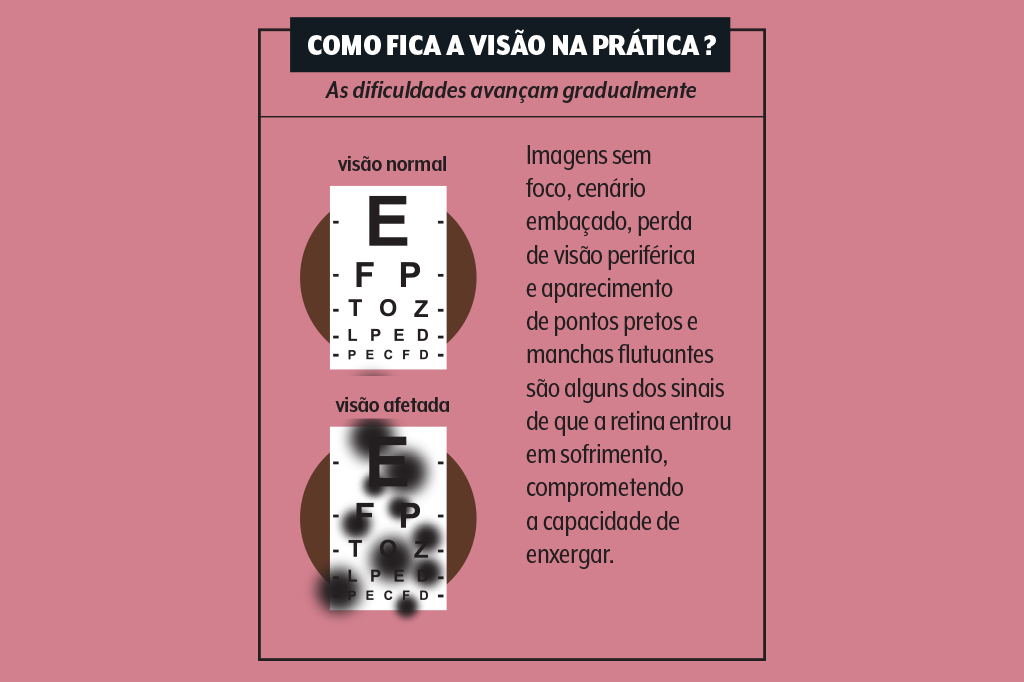 508-sqs-retinopatia-diabetica-quadro1 retinopatia-diabetica