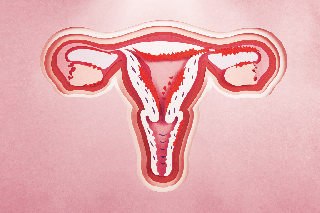 Endometriose: como funcionam os novos tratamentos que chegam ao SUS