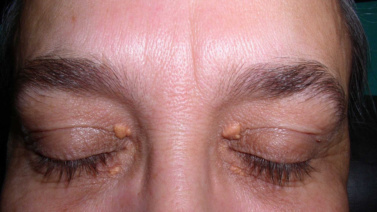 xantelasma-palpebras-colesterol-alto