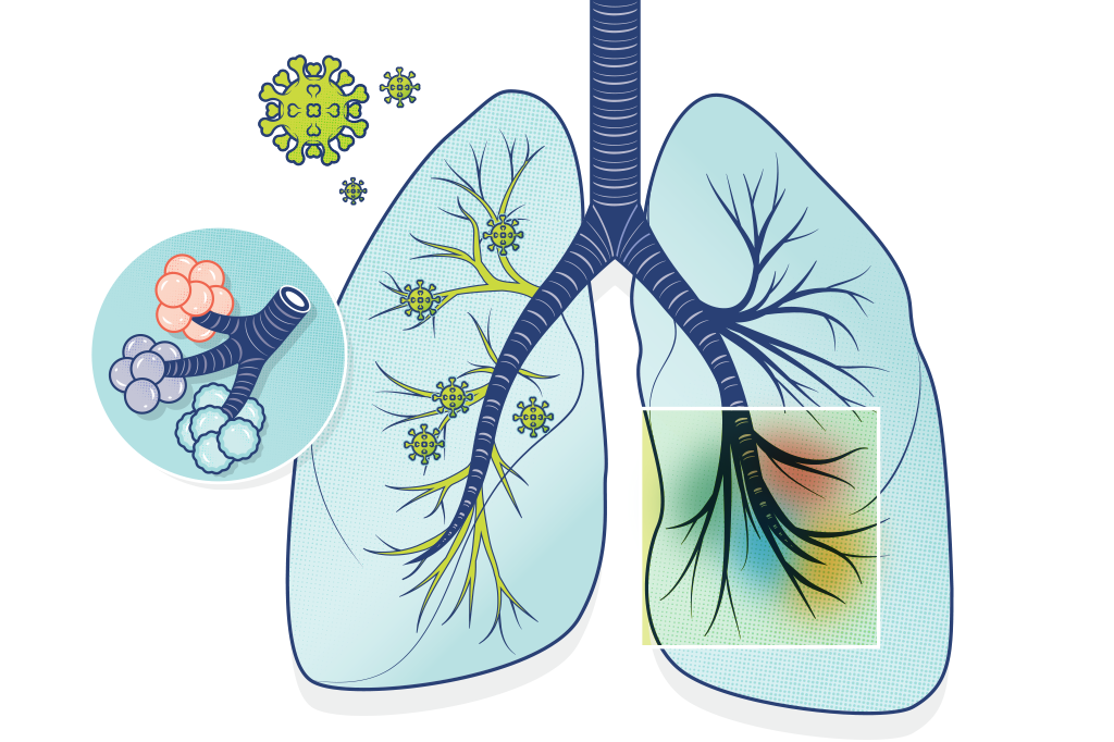 Tecnologia ajuda a prever quem terá sequelas da covid-19