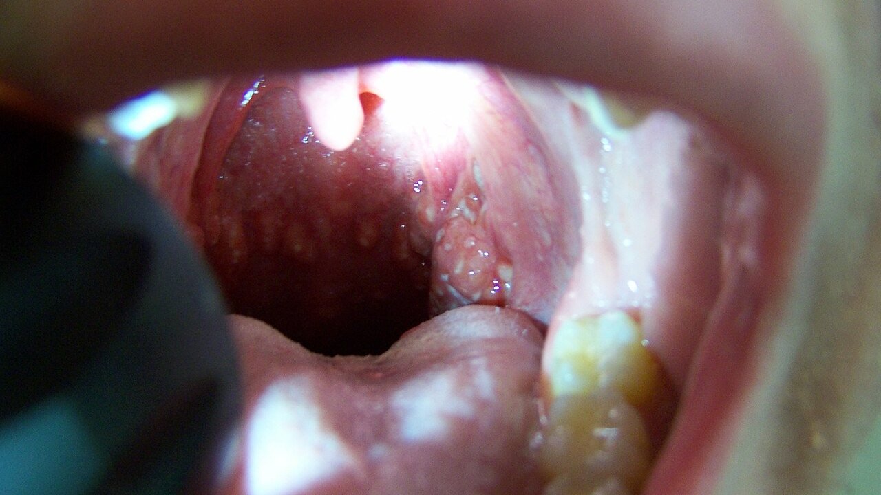 herpangina-infeccao-boca