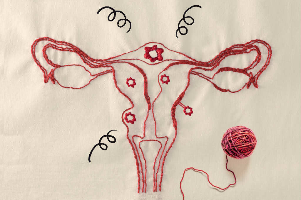 miomas-utero