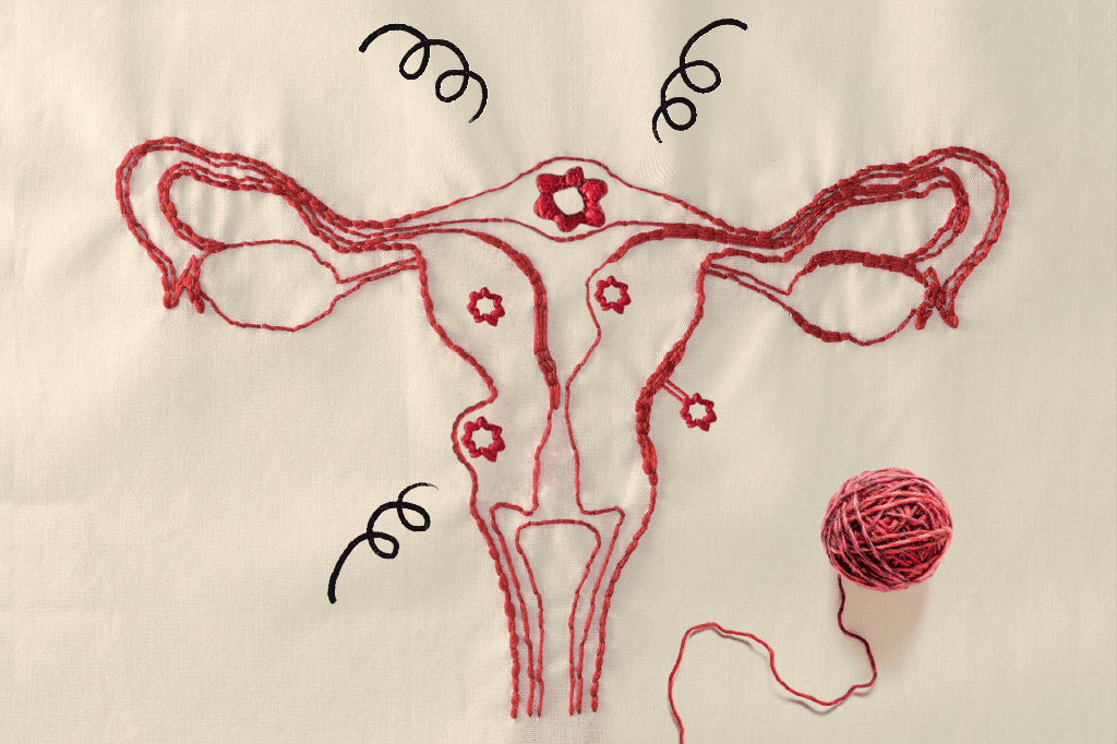 Miomas: tudo sobre o problema que atinge até 80% das mulheres