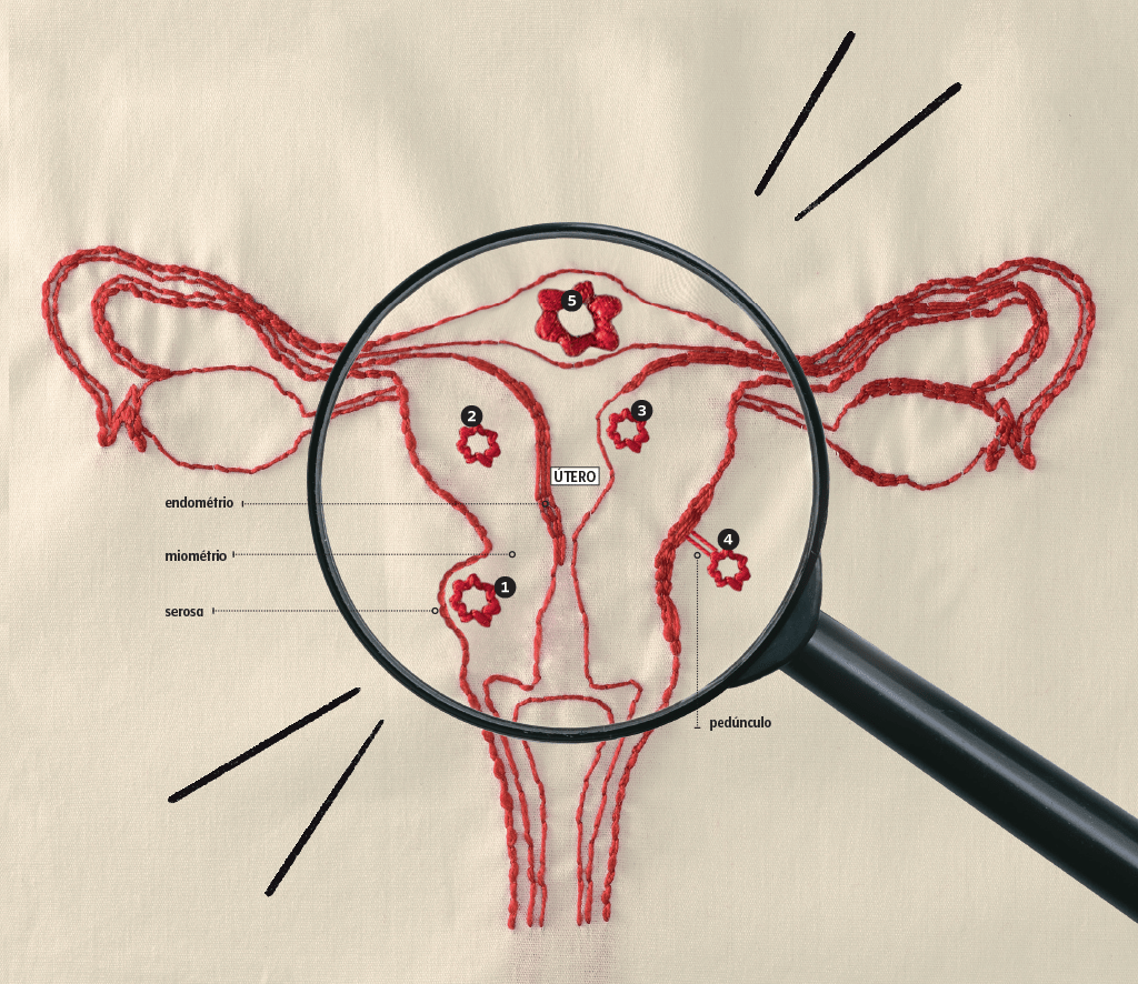 miomas-utero miomas-utero