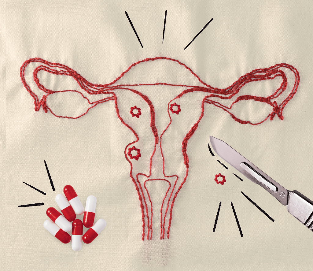 miomas-utero miomas-utero