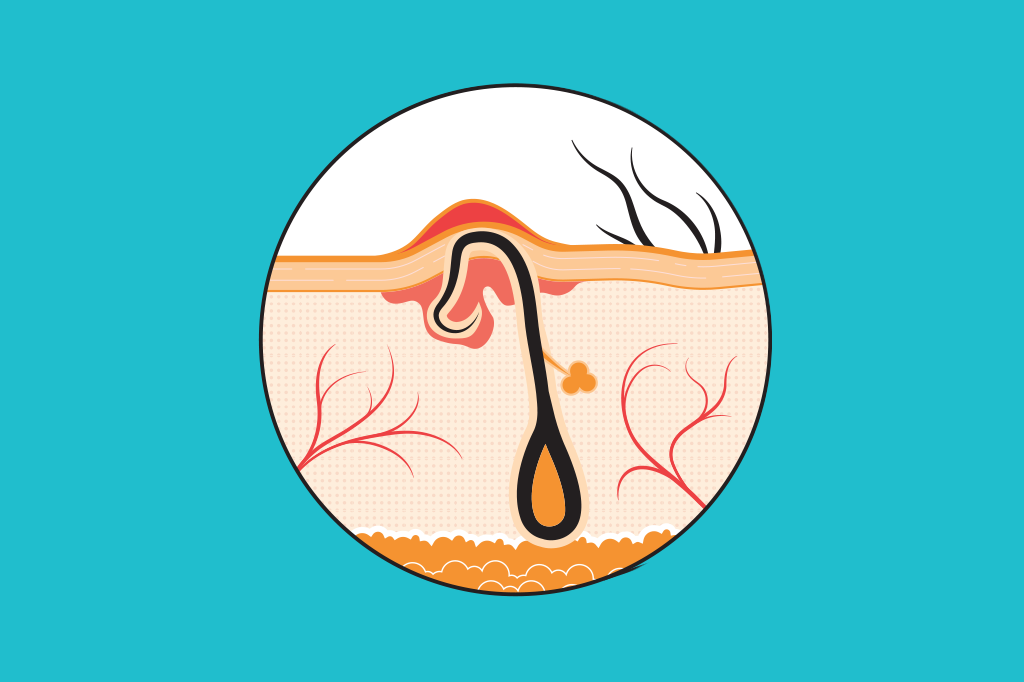 Por que um pelo fica encravado?