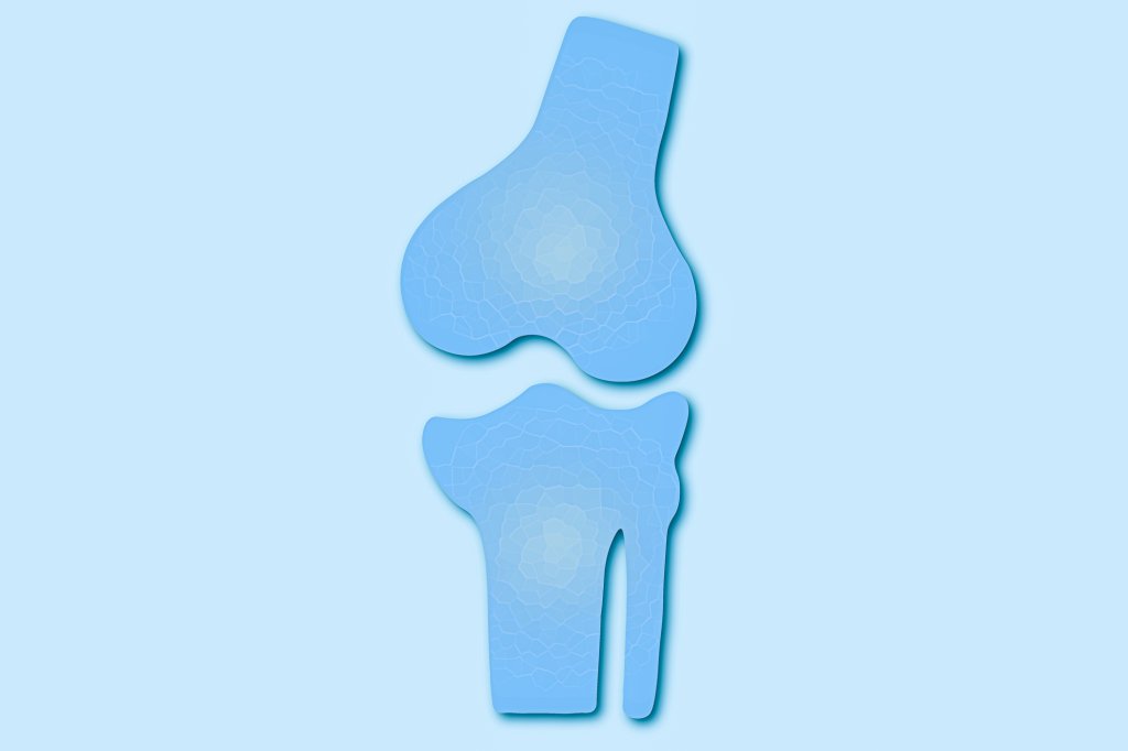 Osteossarcoma: o que é, sintomas e como tratar o câncer de osso mais comum