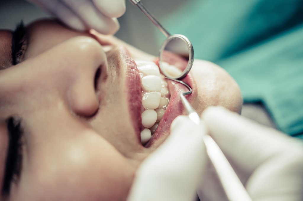 Restauração dental: saiba quando o procedimento é necessário