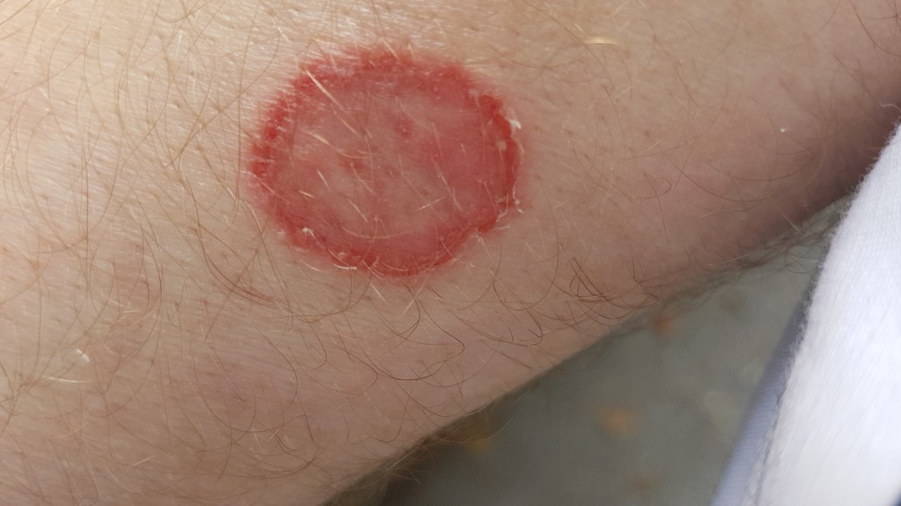 dermatofitose