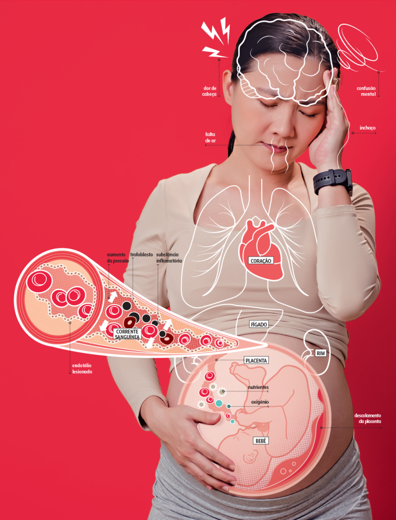 pre-eclampsia-como-acontece