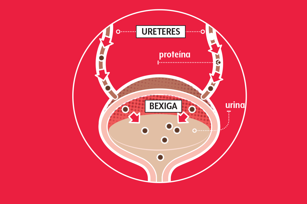 bexiga-pre-eclampsia bexiga-pre-eclampsia